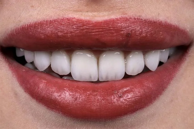 emax-dental-after-768x512
