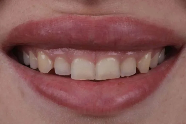 emax-dental-before